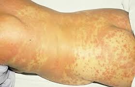 They may develop it early or late in life. Dermatologic Diseases In Pregnancy Glowm
