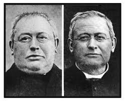 Image result for myxedema