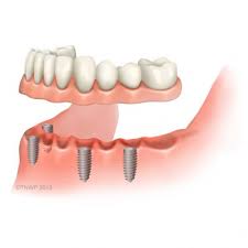 Maybe you would like to learn more about one of these? Teeth And Dentures Supported By Dental Implants