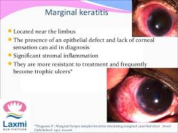 Residents and fellows contest rules | international ophthalmologists contest rules. Herpes Simplex Keratitis Herpes Zoster Opthalmicus
