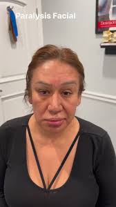 Bell’s Palsy first consultation treatment