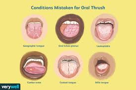 Image result for brown tongue symptoms