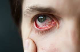 Geplatzte Ader Im Auge Ursachen Und Ob Es Gefahrlich Ist
