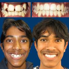 No Extractions, No Surgery, just a GREAT SMILE 🎉🎉🎉 Amazing  transformation in less than 2 years🎉👏 This patient was given the option  of surgical removal of 4 adult premolar teeth, however, at