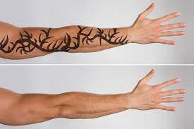 Laser tattoo removal looks different for everyone since each person and their tattoo is unique. Laser Tattoo Removal How Long Does It Take To See Results