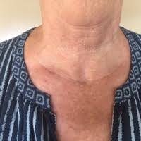 It is difficult to be very specific without having more detailed information. Testimonials And Great Stories From Thyroid Patients Of Gary Clayman Md