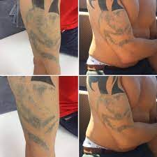 By the end of three sessions, most of the darkest portions of the original tattoo were significantly faded. Black Tribal Tattoo 13 Picosure Treatments And It Has Stopped Working Should I Carry On With Treatments Photos