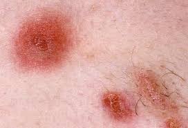 What Is Mrsa Impetigo Signs And Symptoms Treatment Diagnosis And Prevention Staph Infection Staph Infection Symptoms Skin Infection