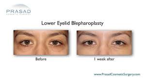 Under Eye Filler For Hollow Eyes Tear Troughs And Under Eye Bags