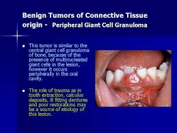 Mouth ulcers or sores that do. Benign Tumors Of The Oral Cavity Benign Tumors