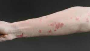 Image result for skin rash acute hiv infection