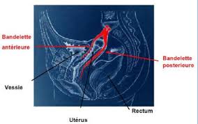 Le traitement du prolapsus génital dépend des symptômes de la femme. Prolapsus Genital Cure Par Promontofixation Coelioscopique Br Urologie Grand Est Paris
