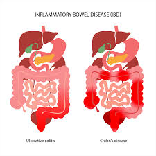 Colon diseases