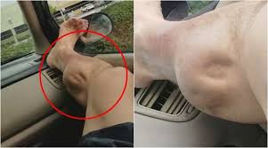 Ini Apa Yang Anda Perlu Lakukan Jika Tiba Tiba Terkena Simpul Mengkarung Ini Apa Yang Anda Perlu Lakukan Jika Tiba Tiba Terkena Simpul Me Fitbit Apa Malaysia