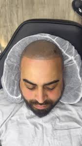 Bring back your confidence with SCALP MICROPIGMENTATION 💉 Instant, natural  & long-lasting results... A quick, effective solution ! NO surgery & NO  complicated maintenance... Choose your look: Natural hairline Modern