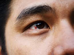 Kali ini saya akan membahas kenapa mata kita merah? Apa Yang Menyebabkan Mata Merah Sihat Net