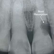 Early Action Needed To Save Your Tooth From Root Resorption Robbinsdale Dentalcare