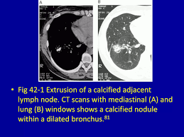 Image result for Broncholithiasis