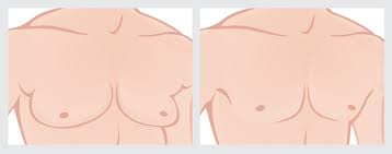 How to know if you have gyno. Gynecomastia After Weight Loss American Society Of Plastic Surgeons