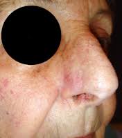 Le cancer de la peau est le plus fréquent des cancers avec plus de 100 000 nouveaux cas annuels en france. Cancer Du Nez Et De La Face