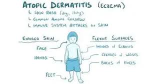 Image result for Allergic Triad