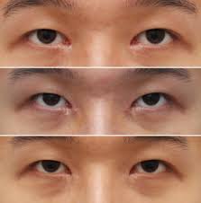 To talk about asian eyes is to have a unique lexicon. Reconstruction Of Medial Epicanthal Fold Using V Y Advancement And Turnover Flap Sciencedirect