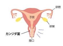 カンジダ症の症状・原因・治療方法－自然治癒する？｜京都の足立病院