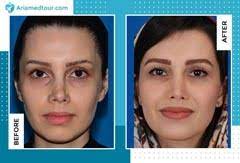 Rhinoplasty surgery also known as a nose job, is performed to reshape a person's nose. Revision Rhinoplasty In Iran Best Surgeons Cost Ariamedtour