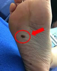 Image result for brown patches on the feet