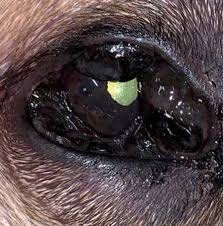 Image result for conjunctival melanoma