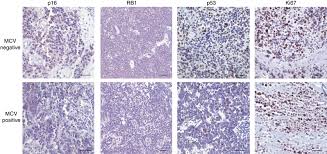 Clinical characteristics of merkel cell carcinoma at diagnosis in 195 patients: Immunohistochemical Characteristics Of Virus Negative And Positive Download Scientific Diagram