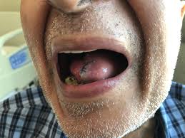 Image result for cancer of tongue