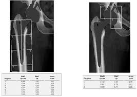 Bone Mineral Density Assessment For Research Purpose Using