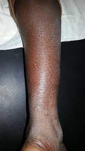 From wikipedia, the free encyclopedia. Xerose Ichtyosiforme De La Jambe Download Scientific Diagram