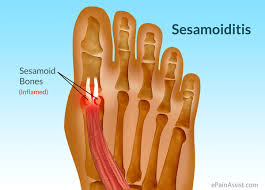 Pin On Big Toe Pain
