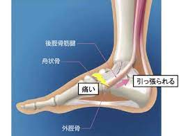 有痛性外脛骨の治し方 痛みのない足を取り戻す方法 ココロもカラダも健康で幸せに 脛骨 痛み 治療