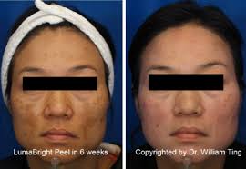 Chai xin ting is a consultant aesthetic physician with a keen eye for skin diseases and aging gracefully. Melasma And Pigmentation Treatment San Ramon California Dermatology