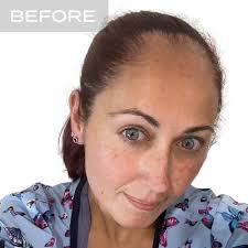 Female Hair Transplant NYC by Nova Medical Hair Transplant