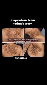 Image result for Diascopy