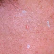 Image result for Sebaceous Hyperplasia