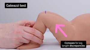 Image result for Galeazzi Sign