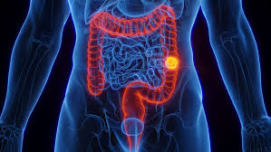 Image result for Colorectal Cancer