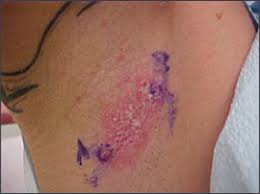 Rashes that occur without other symptoms are usually minor and often go away with home treatment. Pruritic Rash In The Intertriginous Areas Photo Quiz American Family Physician