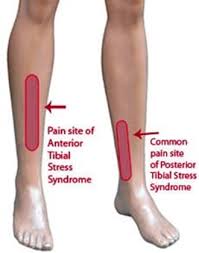 The term shin splints, also called medial stress syndrome, refers to pain felt along the sides of the shin bones after physical activity. Shin Splints Recognition Treatment Fleet Feet Columbus