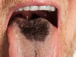 Image result for black tongue symptoms