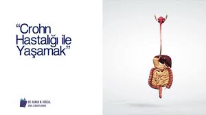 Crohn hastalığı, sindirim sistemi ya da gi (gastrointestinal sistem) iltihaplanmasına neden olan süregelen bir hastalıktır. Dr Hakan M Koksal Crohn Hastaligi Ile Yasamak Facebook