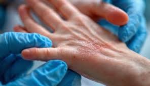 Image result for Human Bite