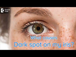 Image result for melanosis sclera