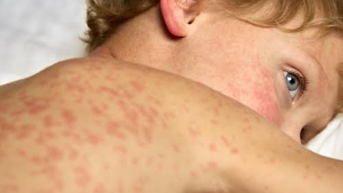 Measles Outbreak 2026: Pennsylvania Cluster Raises Vaccine Hesitancy Concerns