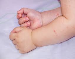 Image result for contact dermatitis